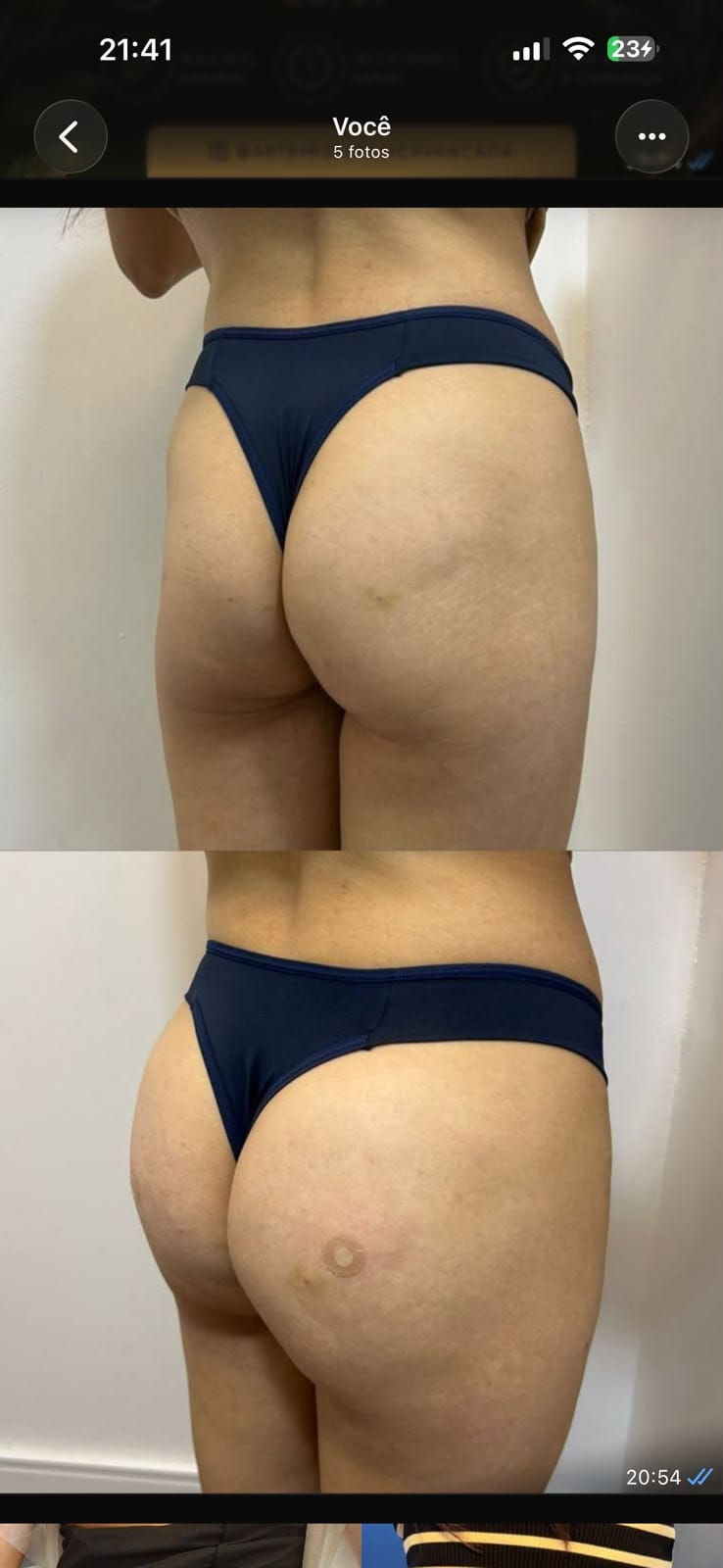 Bumbum brasileiro antes e depois