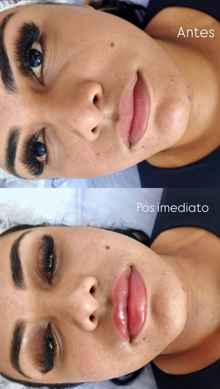 Lábios antes e pós imediato