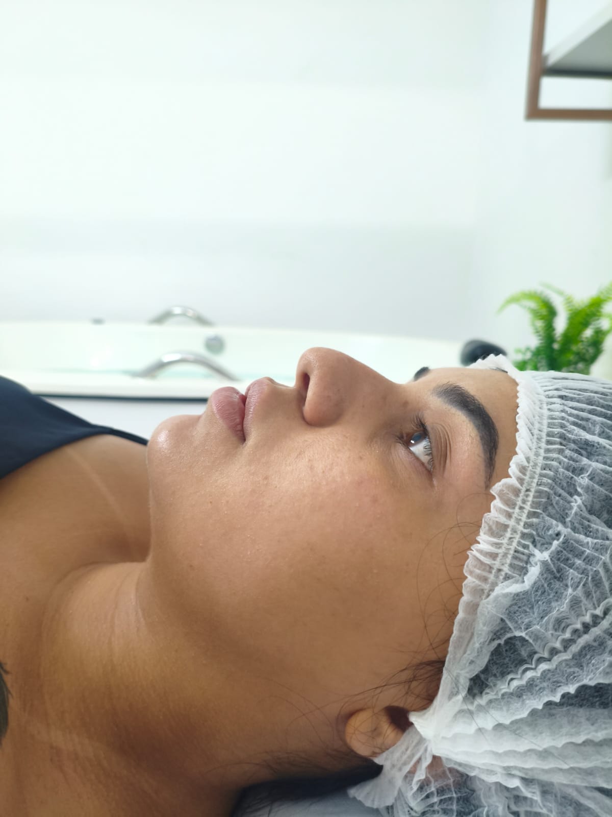 Antes - Aline Rodrigues Estética Avançada e Humanizada