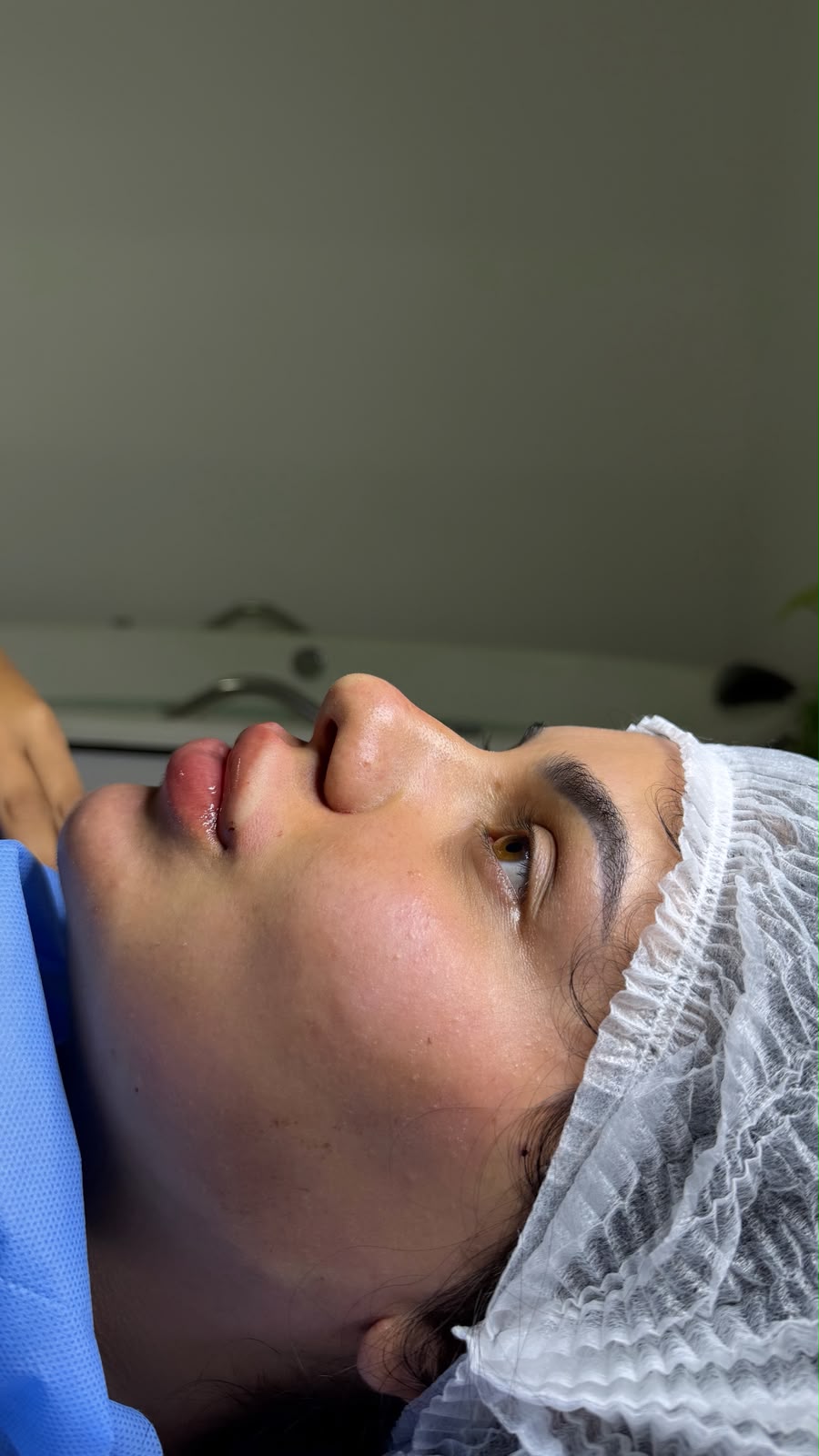 Depois - Aline Rodrigues Estética Avançada e Humanizada