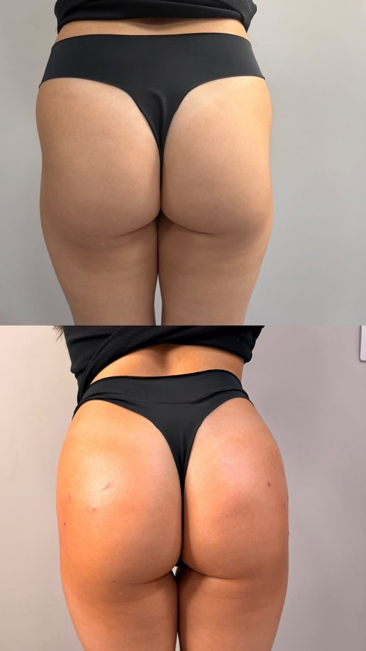 Bumbum brasileiro antes e depois